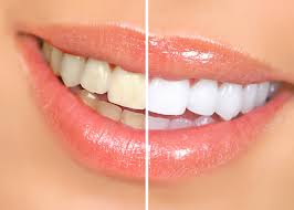 を する 歯 白く 「歯を白くするホワイトニング歯磨き粉」歯科衛生士が選ぶランキング